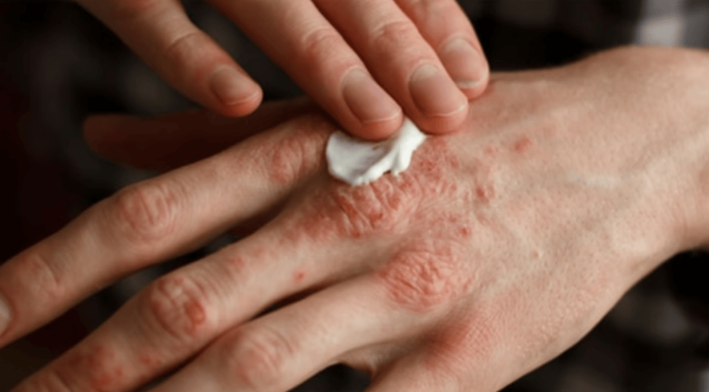 استشارية: الصدفية مرض التهابي مزمن يؤثر على الجلد والمفاصل