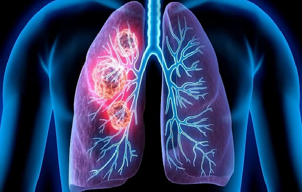 تجمع المدينة المنورة الصحي يوضح حقائق حول سرطان الرئة