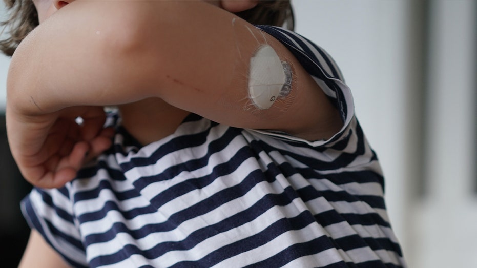 طفل لديه جهاز استشعار لمراقبة الجلوكوز