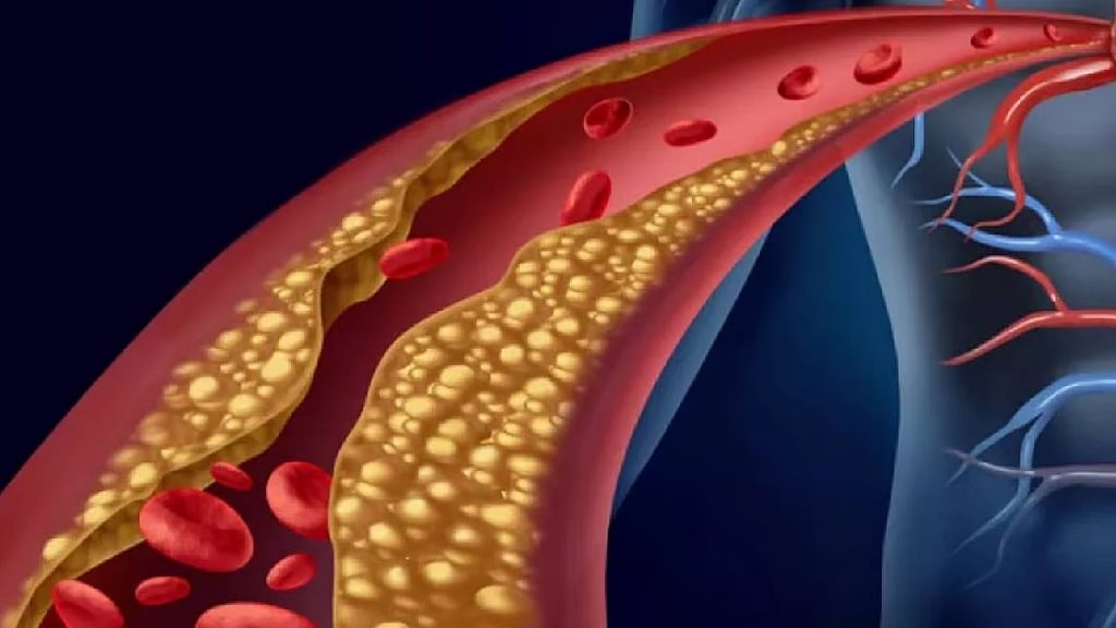 فهد الطبية توضح عوامل خطورة الإصابة بتصلب الشرايين والأمراض الناتجة عنه