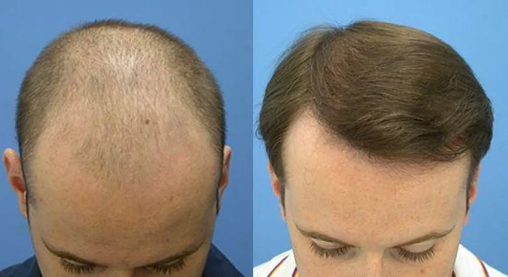 ميتا تايتل: تعرف على أفضل مراكز زراعة الشعر في السعودية| رام